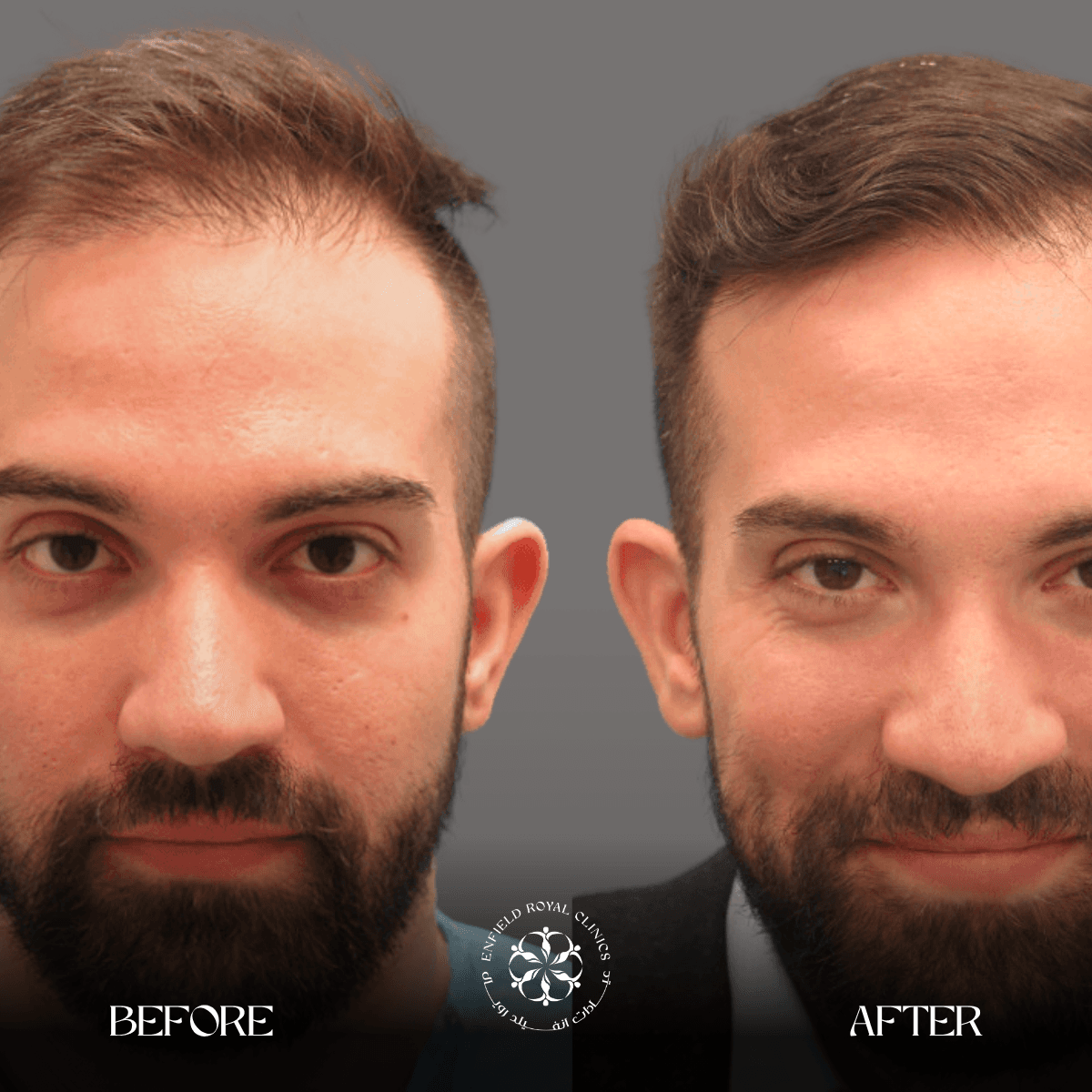 Cosmetic Surgery in Riyadh | Enfield Royal Saudia 14 Hair Transplant 2