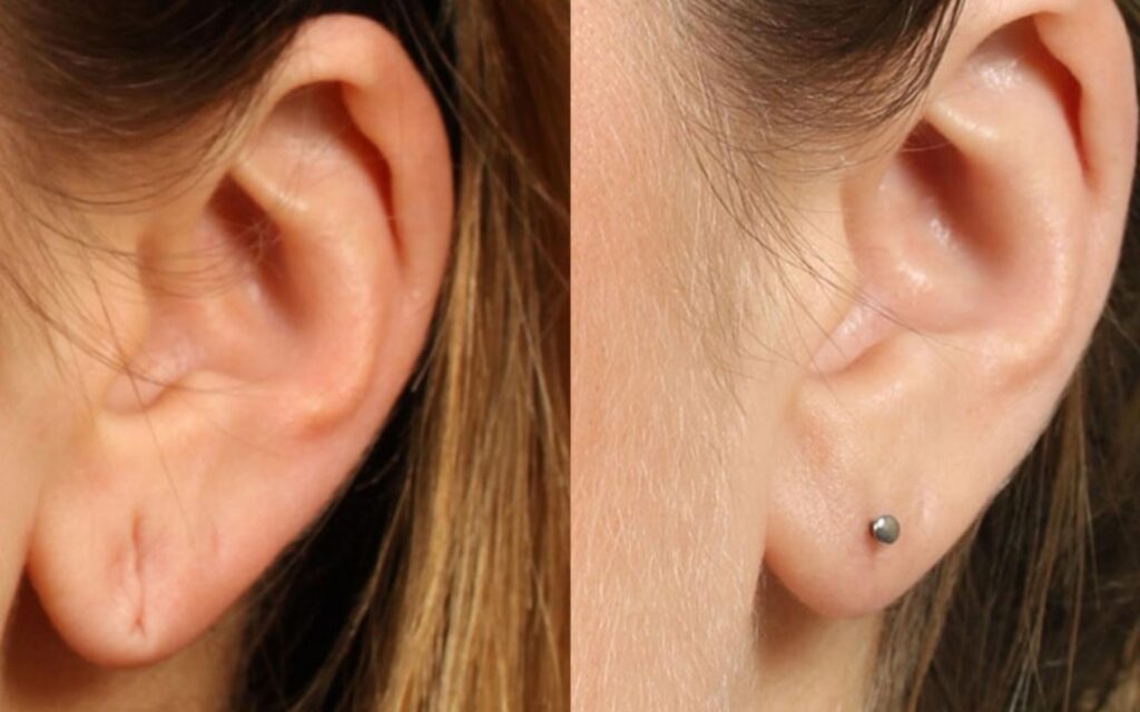 earlobe reduction before after
