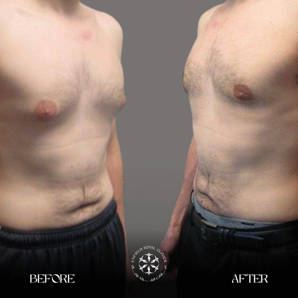 Gynecomestia Before after