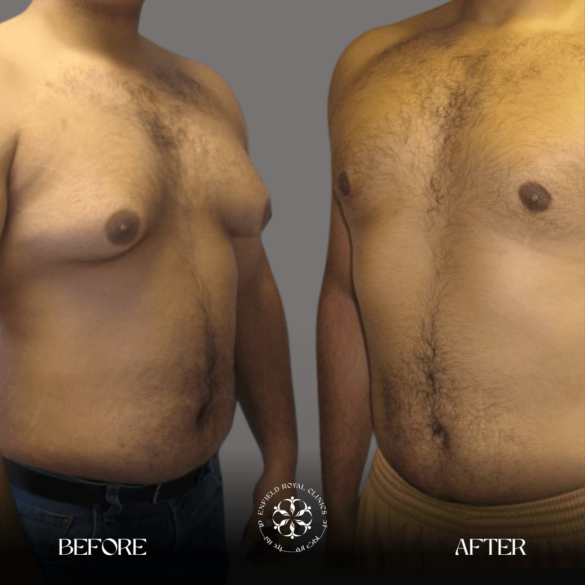 Cosmetic Surgery in Riyadh | Enfield Royal Saudia 18 Gynecomestia befoer and after