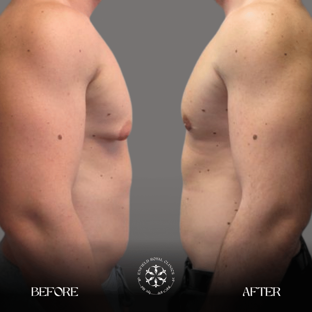 Gynecomestia before after results