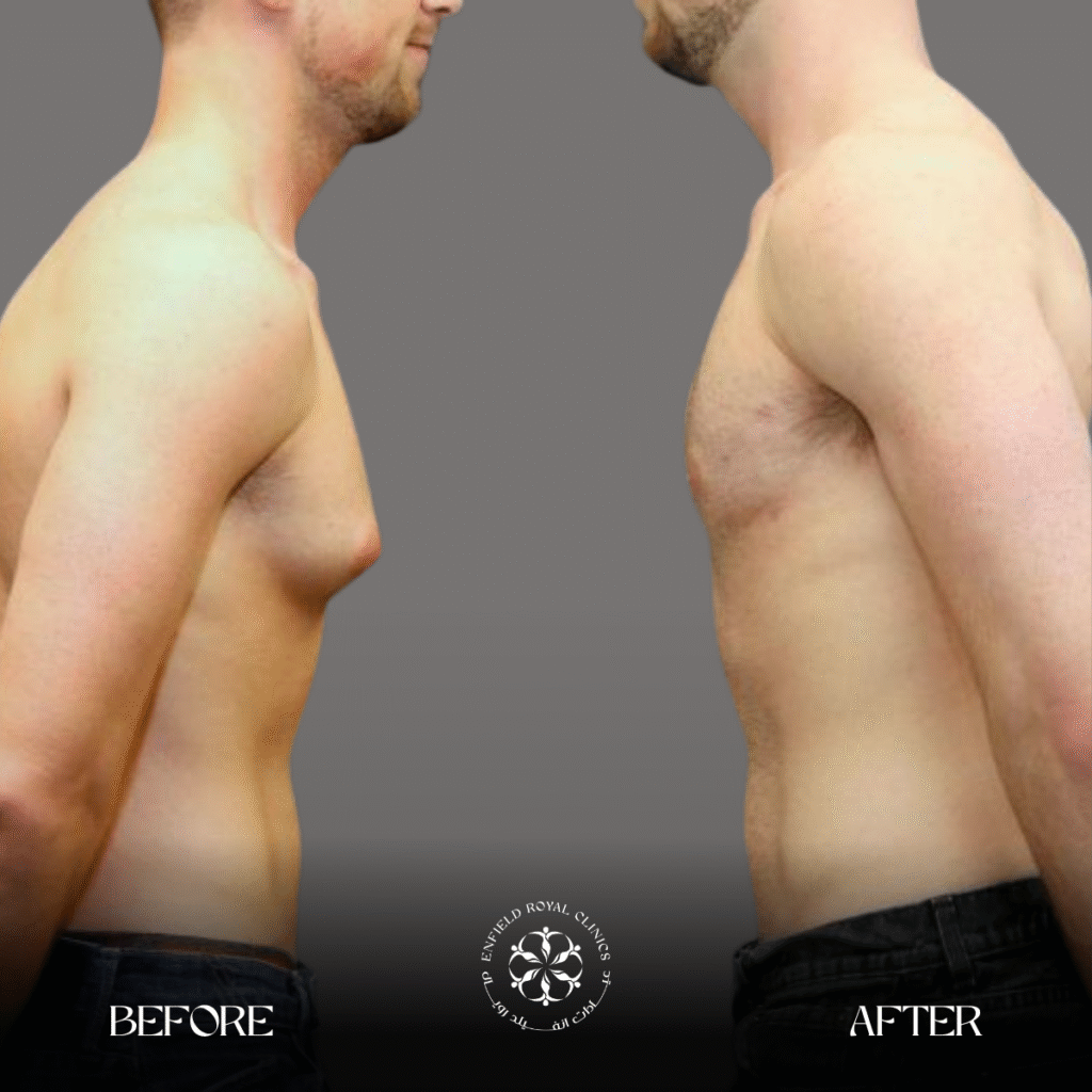 gynecomestia male breast reduction