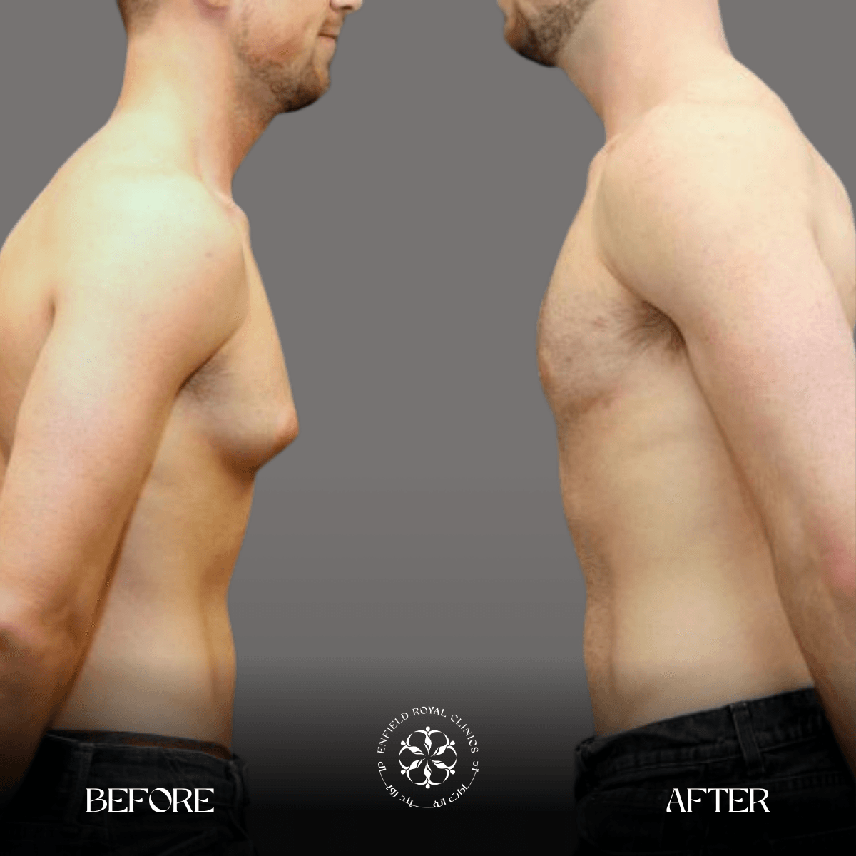 Cosmetic Surgery in Riyadh | Enfield Royal Saudia 13 gynecomestia male breast reduction