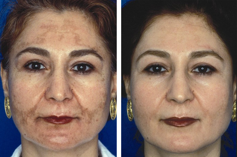 Chemical Peels in Riyadh 4 Chemical Peel for Melasma Before and After