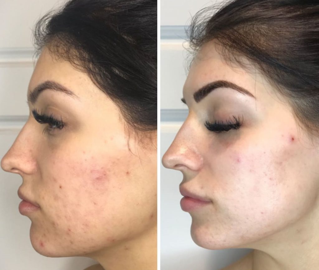 Chemical Peels in Riyadh 5 Chemical Peel for Pigmentation Before and After