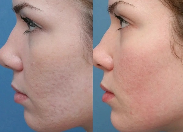 Hydrafacial before and after pores