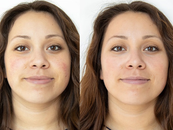 hydrafacial before AFTER