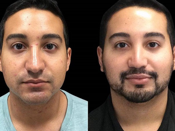 hydrafacial before and after men