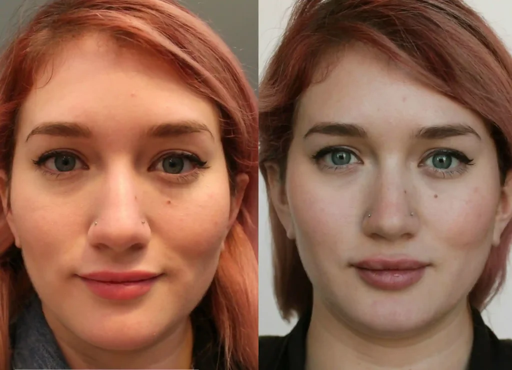 Salmon DNA injection Before and After