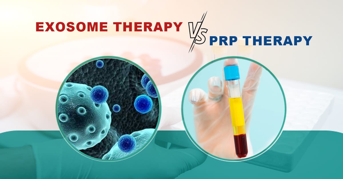 exsome vs PRP