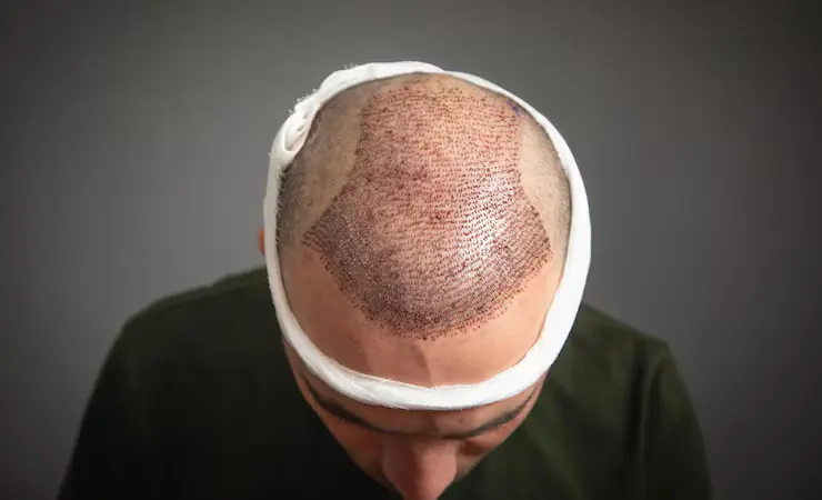 Advancements in Hair Transplant Techniques 2026