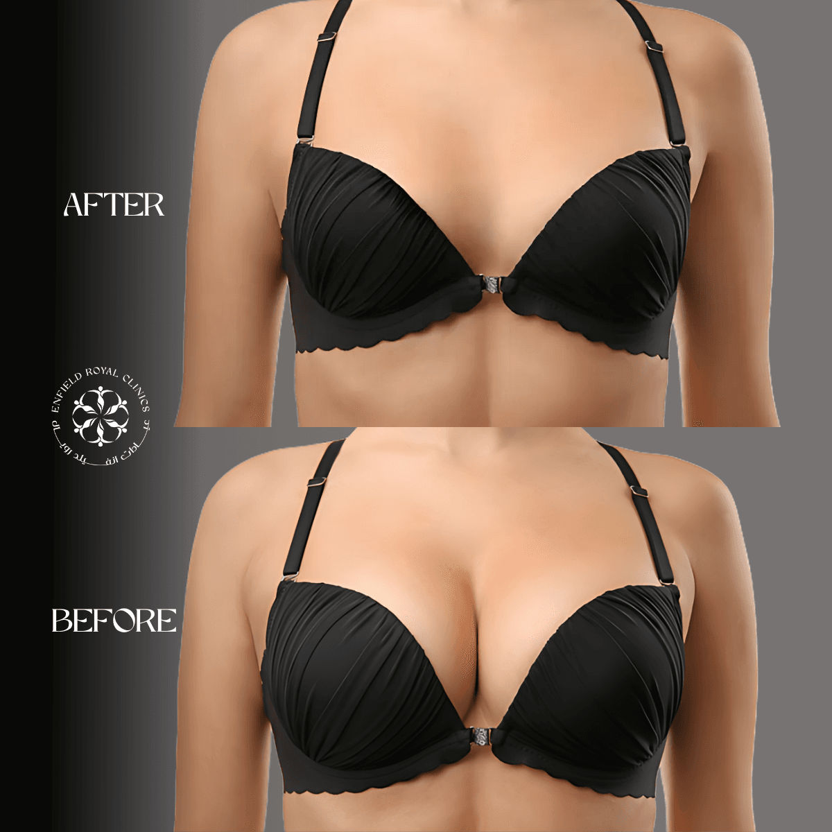 Cosmetic Surgery in Riyadh | Enfield Royal Saudia 12 Breast Reduction befor after