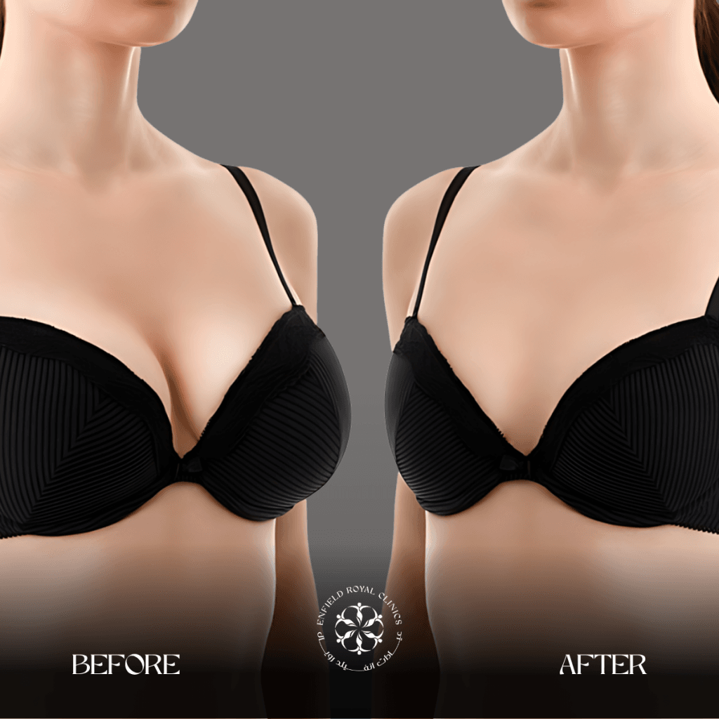 Breast Reduction before & after