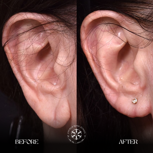 Earlobe Reduction Before After