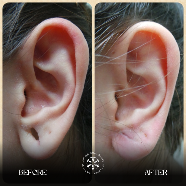 Earlobe correct surgery before after results