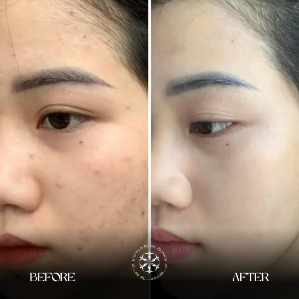 Gluta before and afte