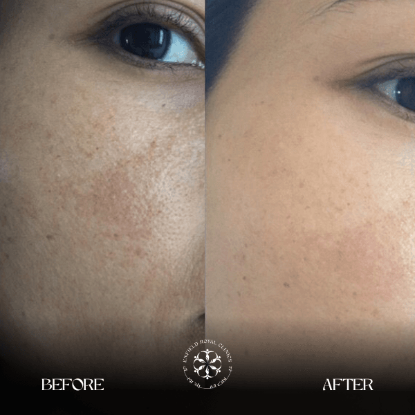 Glutathione before and after