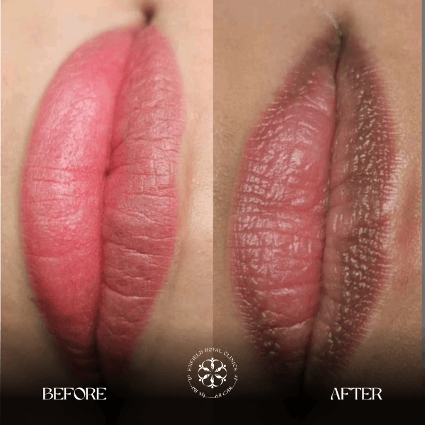 Smokers Lips Before After