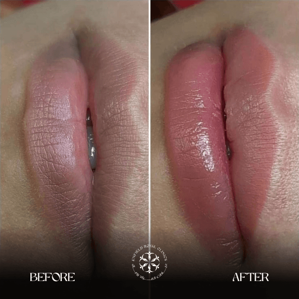 Smokers Lips Before and After results