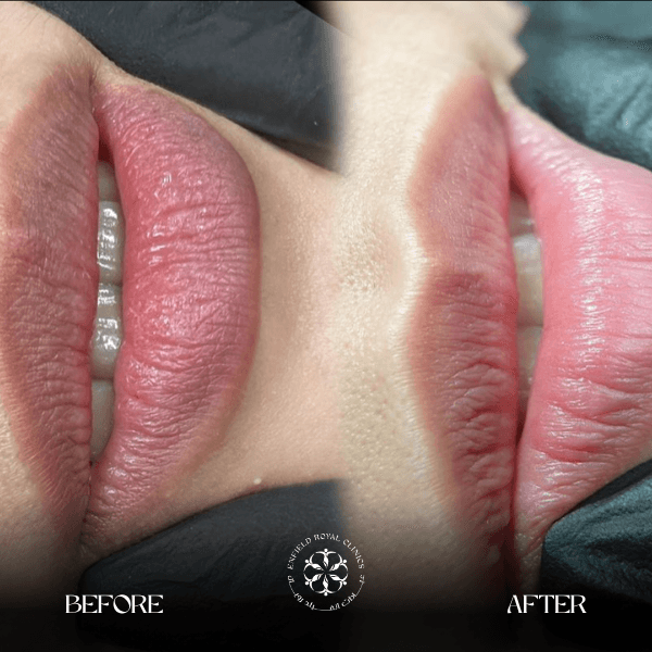 Smokers Lips Before and After