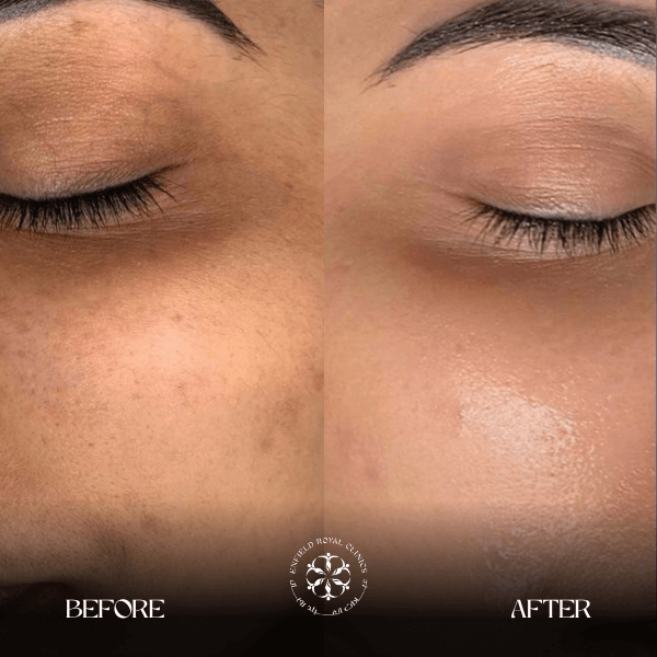 before after dark circles