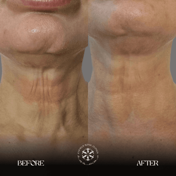 before and after venus legacy