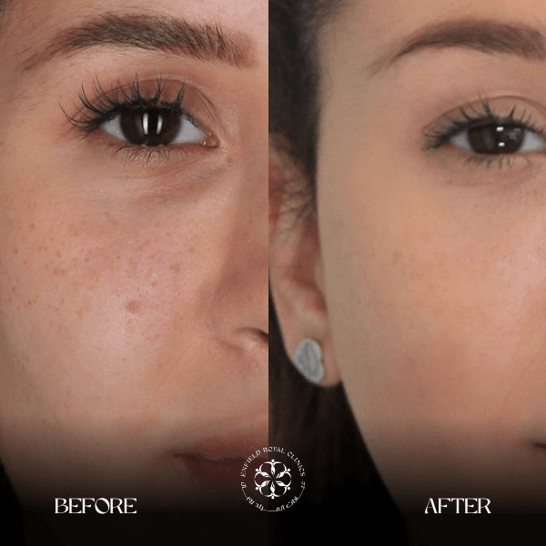 dark circles before and after