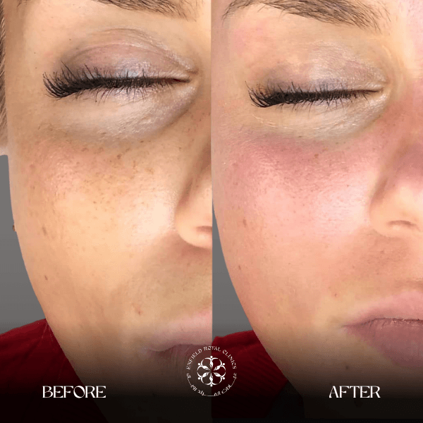 dark eye circles before and after