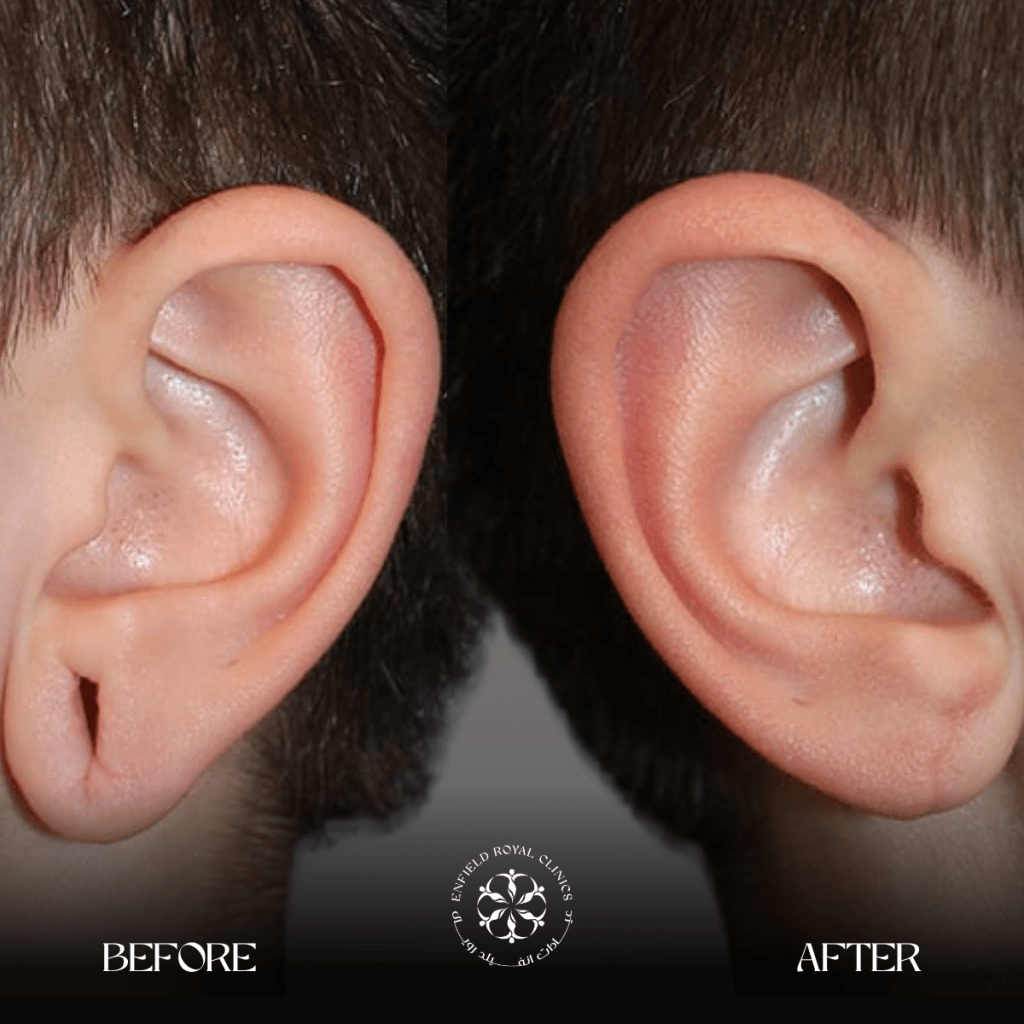 ear reshaping before after results