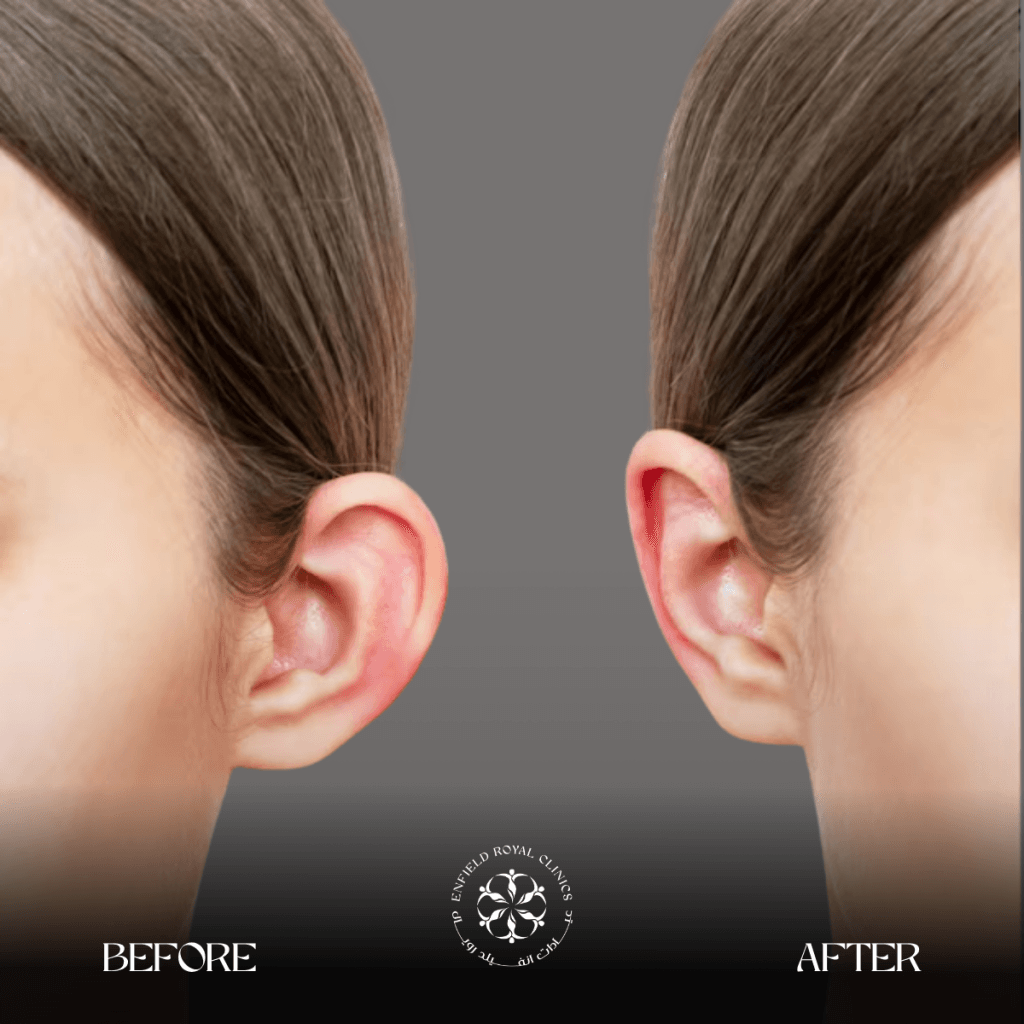 ear reshaping before and after