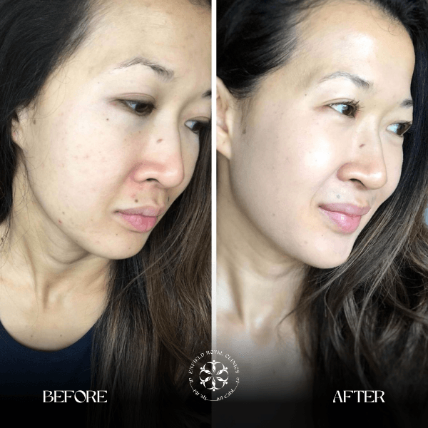 glutathione before after