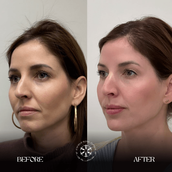 glutathione for skin whitening before and after