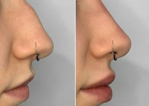 rhinoplasty in dammam