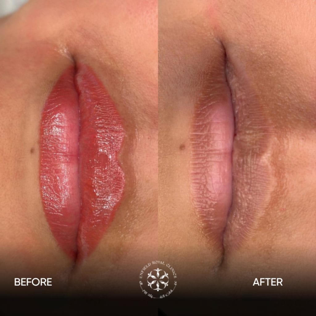 sMOKERS LIPS TREATMETRN BEFORE AFTER
