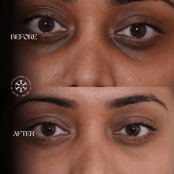 under eye laser treatment before and after