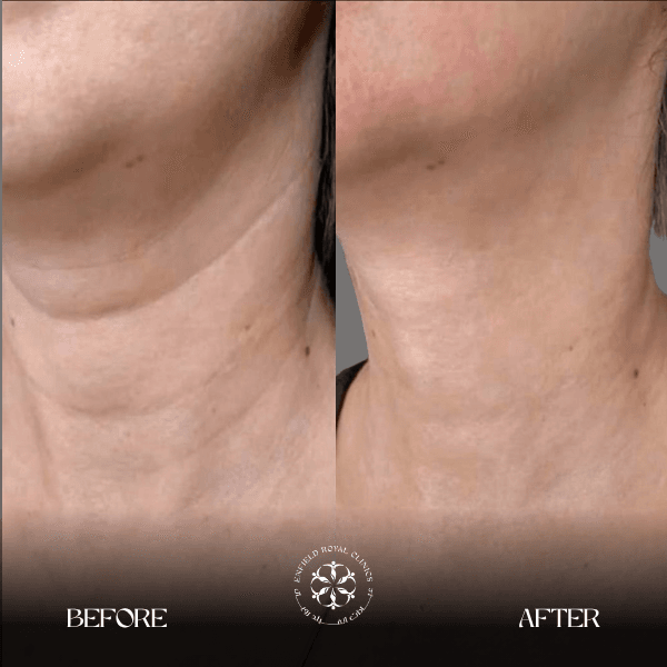 venus legacy skin tightening before and after