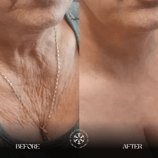 venus legacy treatment before and after