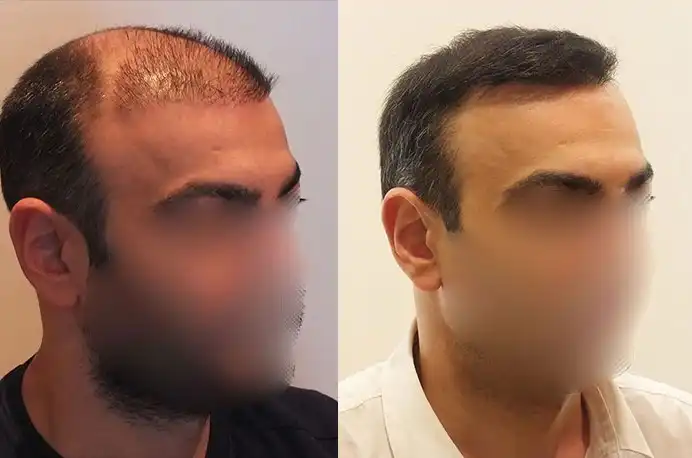 FUE Hair Transplant Before After