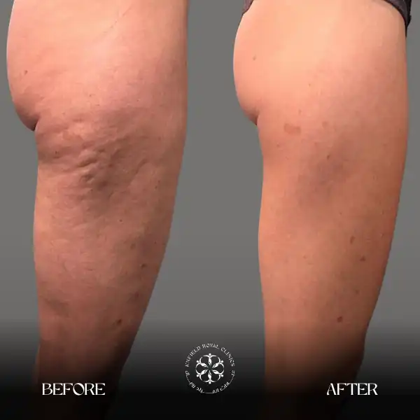 Lipedema Before After Results
