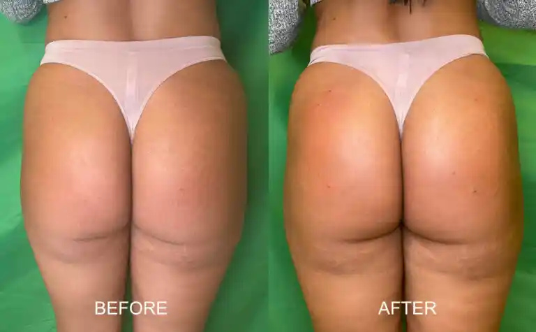 Non Surgical Bum Lift Before After