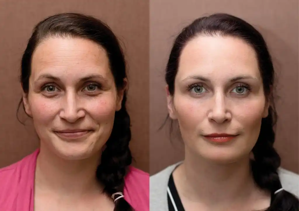 Sculptra Before and After