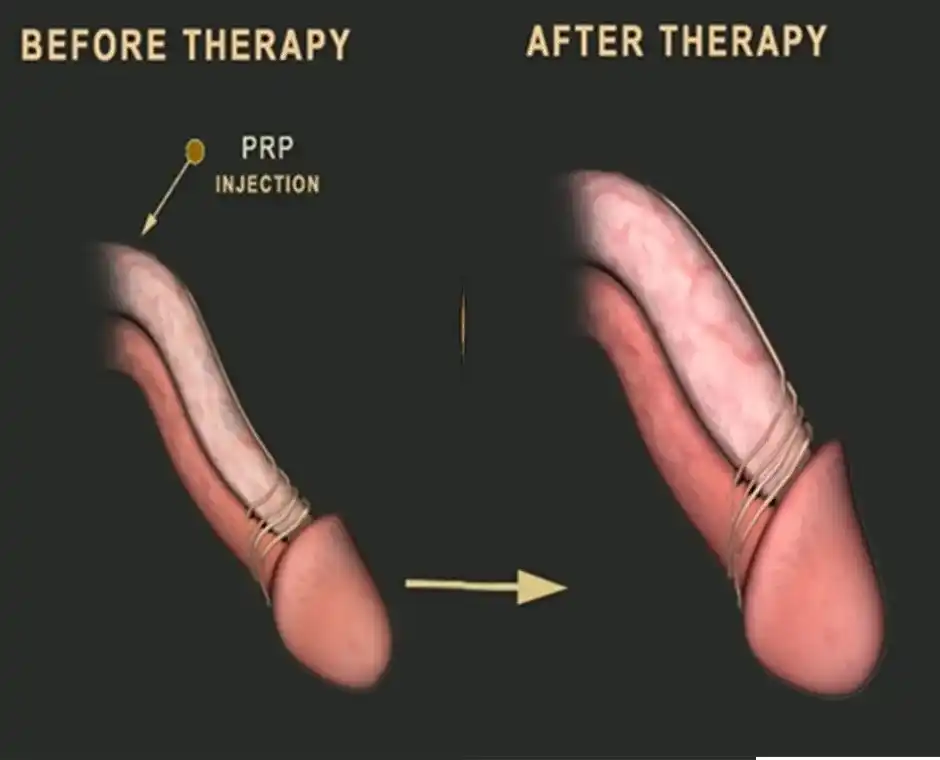 p-shot before and after