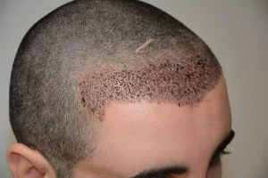 Advancements in Hair Transplant Techniques 2026