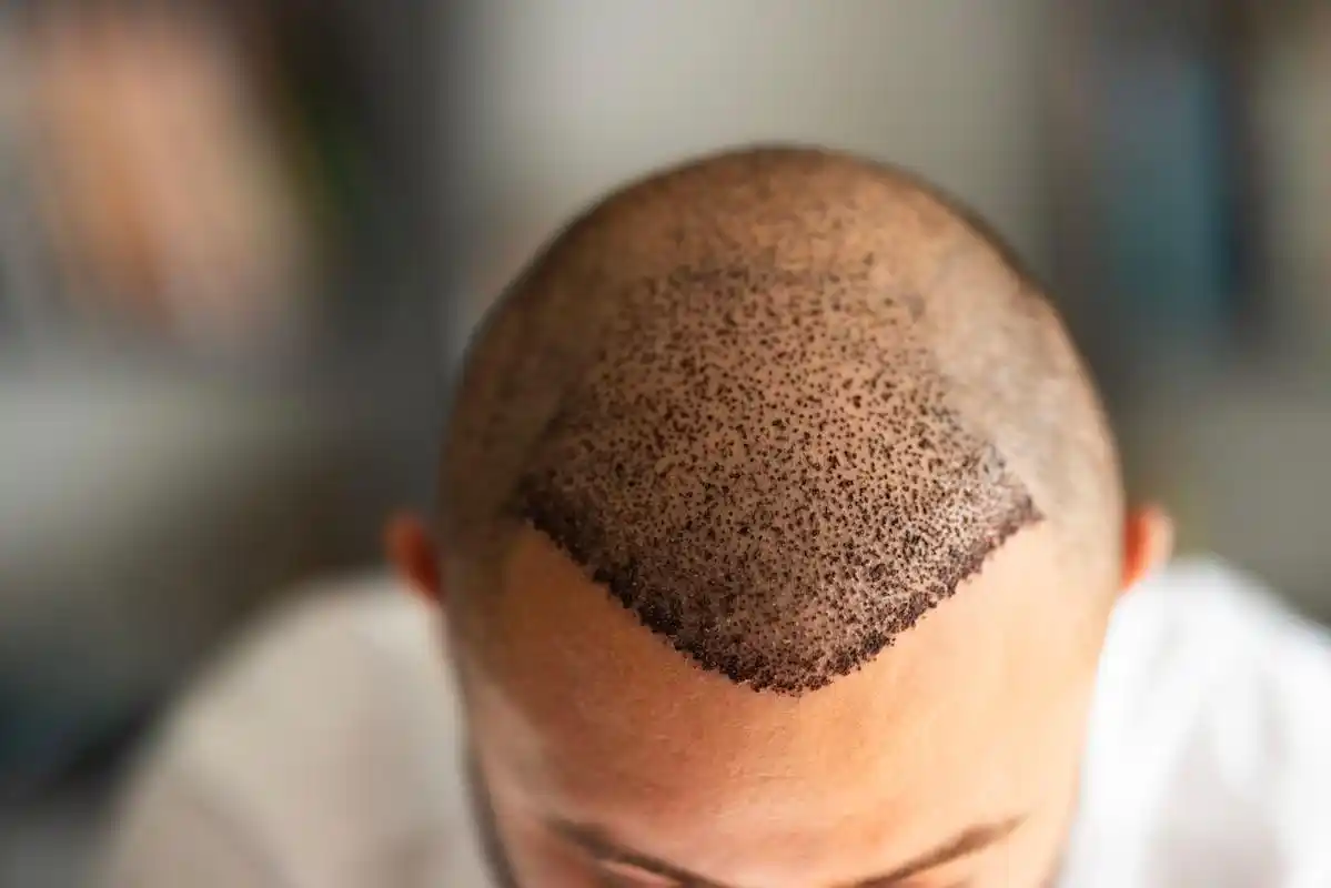 Hair Transplant Cost in Saudi Arabia 2026