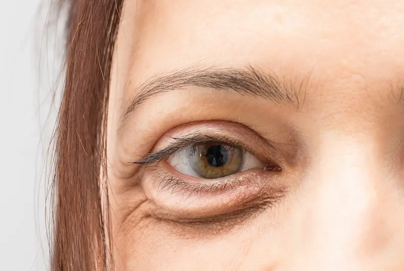 How to Get Rid of Eye Bags