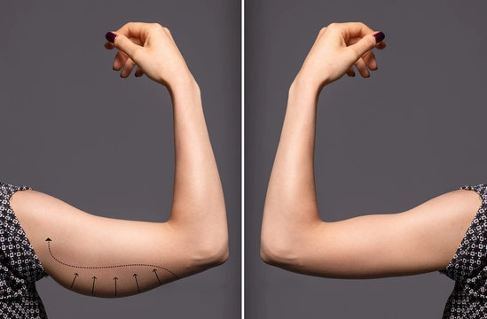 Arm Lift Surgery Before After