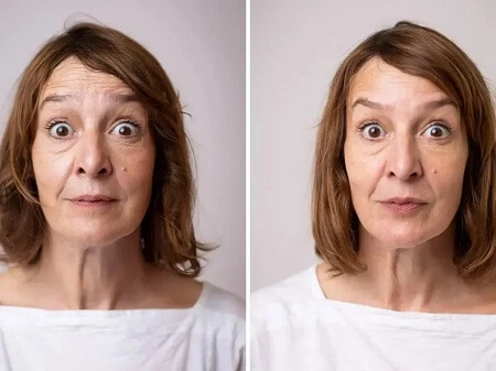 Botox Injections Before after images