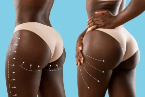 Can Brazilian Butt Lift Be Done During Menstruation
