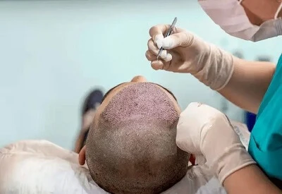 DHI Hair Transplant Cost in Riyadh