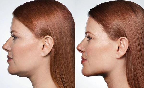 Double Chin Liposuction Before after results